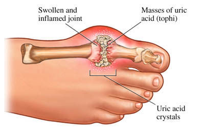 Gout in foot